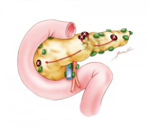 Pancreatic cancer that has spread to lymph nodes is considered "N1" disease